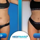 Liposukcja brzucha przed i po: wyraźna zmiana sylwetki. Widoczna redukcja tkanki tłuszczowej i wymodelowanie talii.