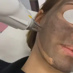 Zabieg laserowy na twarz z maską węglową. Peeling węglowy w trakcie działania.
