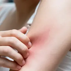 Dłoń drapie zaczerwienioną skórę ramienia, która swędzi wieczorem.