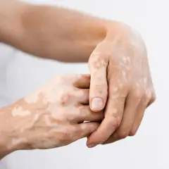 Dłonie z widocznymi jasnymi plamami. To bielactwo, co to za schorzenie?