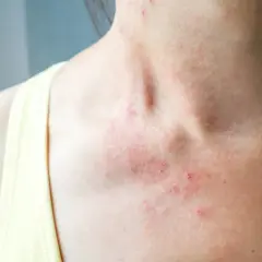 Widoczna wysypka na szyi i dekolcie, zaczerwienione, swędzące zmiany skórne.
