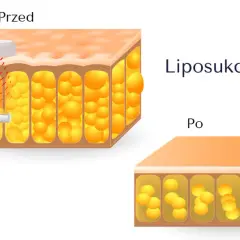 Przed i po zabiegu liposukcji kawitacyjnej: zmniejszenie komórek tłuszczowych pod skórą.