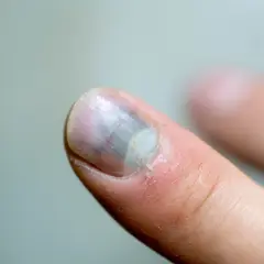 Zasiniony paznokieć po urazie. Widoczne ciemne przebarwienia i uszkodzenia płytki paznokciowej.