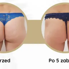 Porównanie pośladków przed i po 5 zabiegach endermologii. Widoczne wygładzenie skóry i redukcja cellulitu. Endermologia efekty.