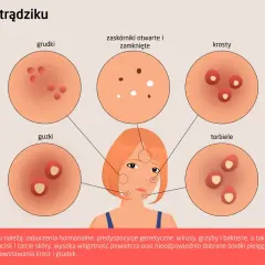 Ilustracja pokazuje różne rodzaje trądziku: grudki, zaskórniki, krosty, guzki i torbiele.
