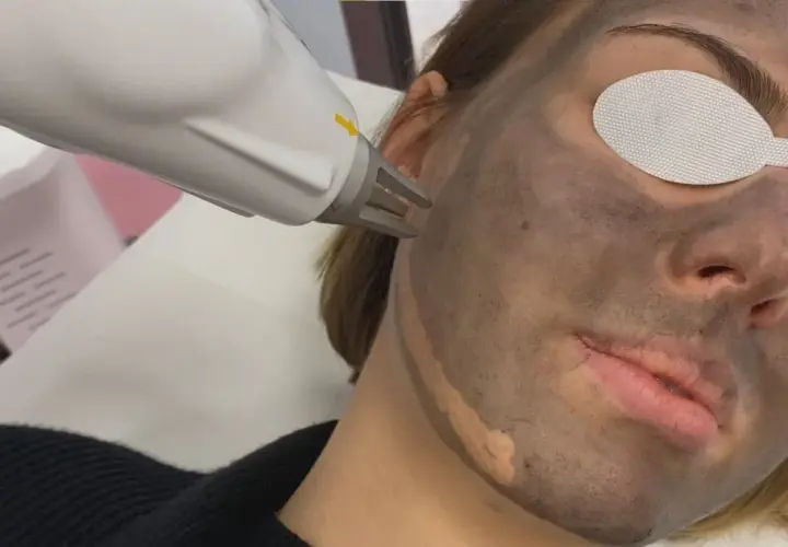 Zabieg laserowy na twarz z maską węglową. Peeling węglowy w trakcie działania.