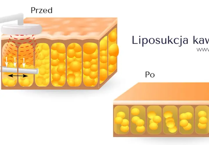 Przed i po zabiegu liposukcji kawitacyjnej: zmniejszenie komórek tłuszczowych pod skórą.