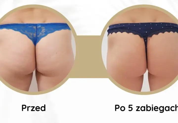 Porównanie pośladków przed i po 5 zabiegach endermologii. Widoczne wygładzenie skóry i redukcja cellulitu. Endermologia efekty.