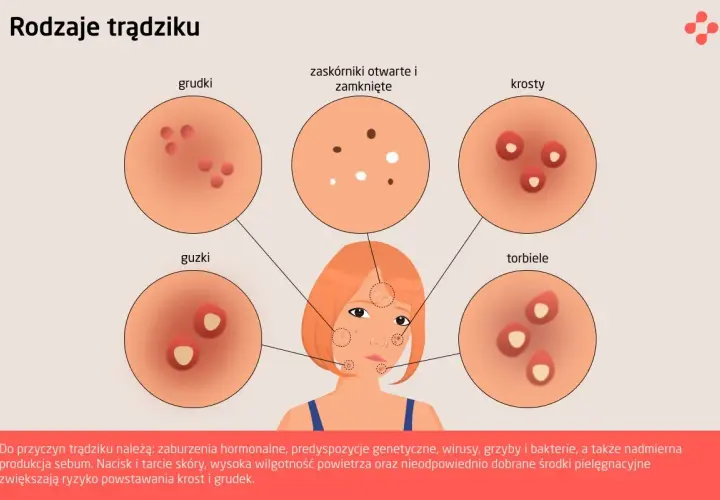 Ilustracja pokazuje różne rodzaje trądziku: grudki, zaskórniki, krosty, guzki i torbiele.