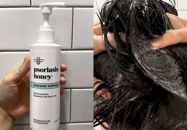 Szampon Psoriasis Honey Renewing Shampoo, idealny do codziennego stosowania, łagodzi skórę głowy. Idealny dla osób z problemami skórnymi, jak łuszczyca.