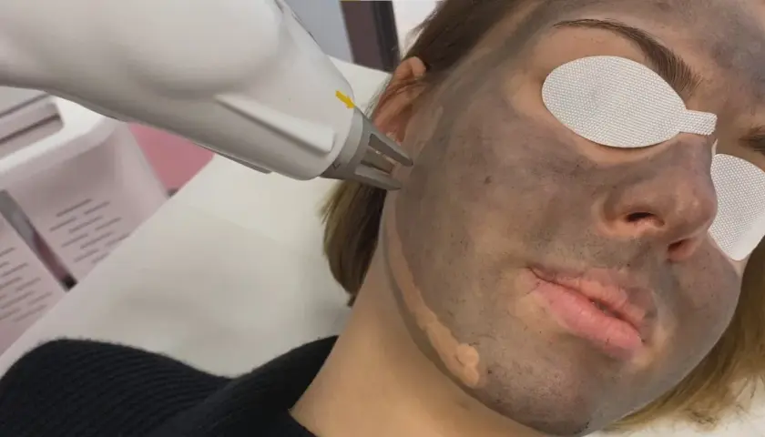 Zabieg laserowy na twarz z maską węglową. Peeling węglowy w trakcie działania.