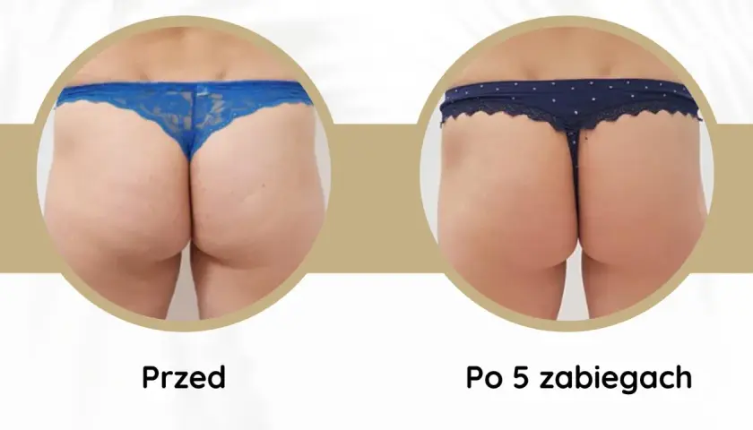 Porównanie pośladków przed i po 5 zabiegach endermologii. Widoczne wygładzenie skóry i redukcja cellulitu. Endermologia efekty.