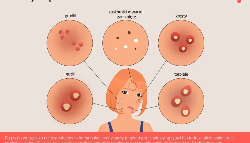Ilustracja pokazuje różne rodzaje trądziku: grudki, zaskórniki, krosty, guzki i torbiele.