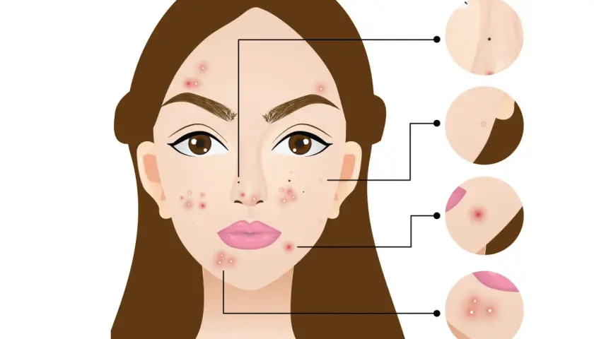 Mapa trądziku: Co lokalizacja pryszczy mówi o Twoim zdrowiu?