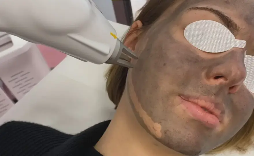 Peeling węglowy - czy naprawdę działa? Poznaj efekty i cenę zabiegu