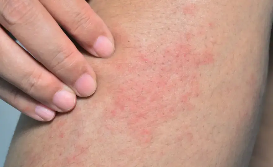 Czerwone plamy na nogach - Co oznaczają i kiedy są groźne?