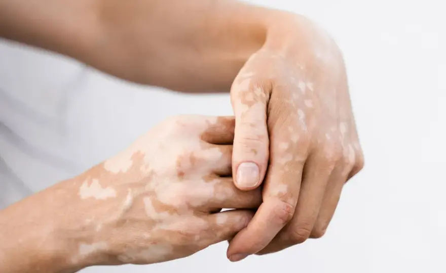 Bielactwo nabyte - jak leczyć białe plamy i dbać o skórę?