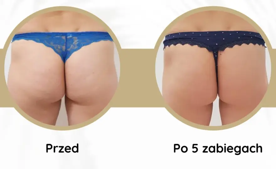Endermologia - efekty, liczba zabiegów i przeciwwskazania