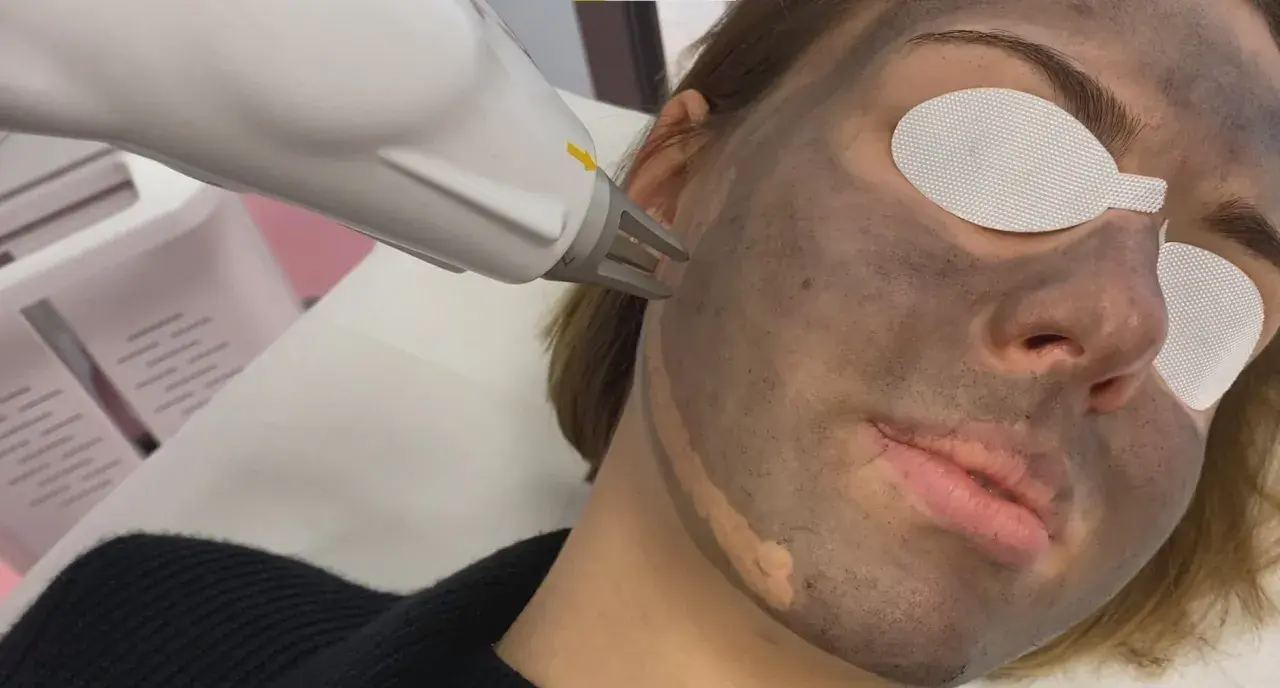 Zabieg laserowy na twarz z maską węglową. Peeling węglowy w trakcie działania.