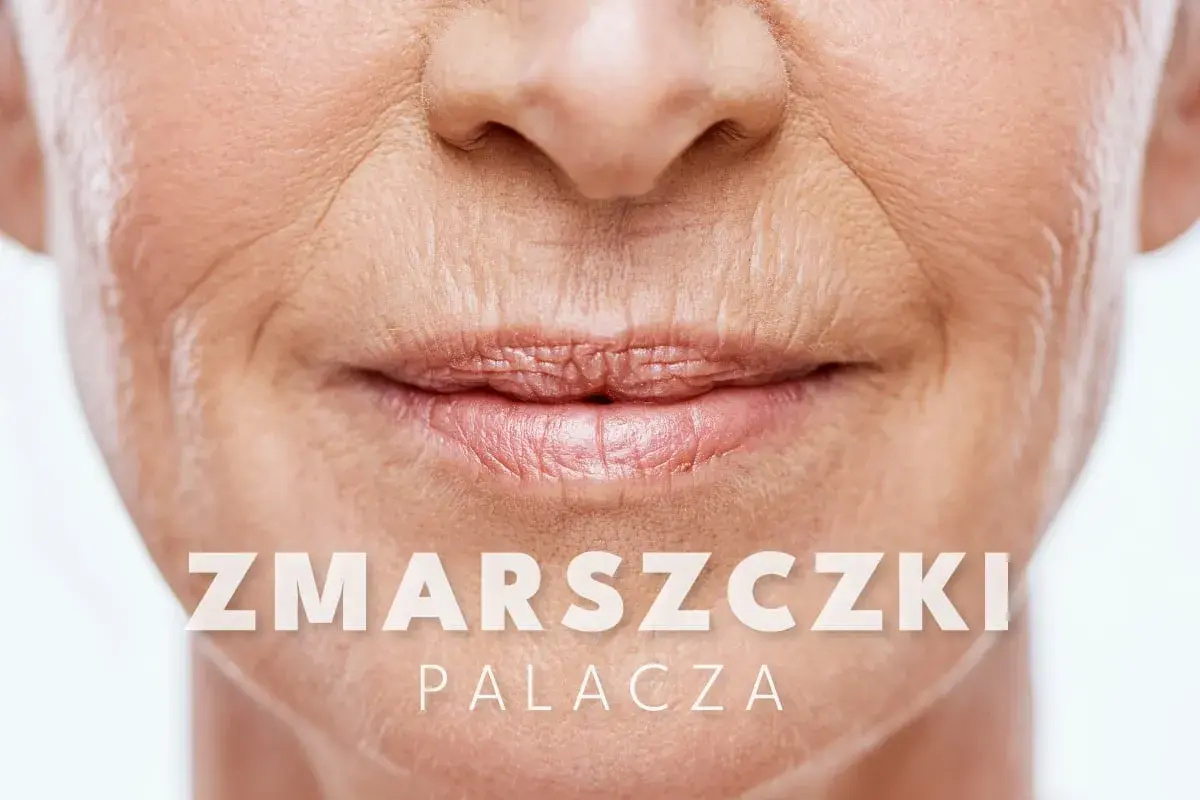 Widoczne zmarszczki palacza wokół ust starszej osoby. Tekst na zdjęciu: "ZMARSZCZKI PALACZA".