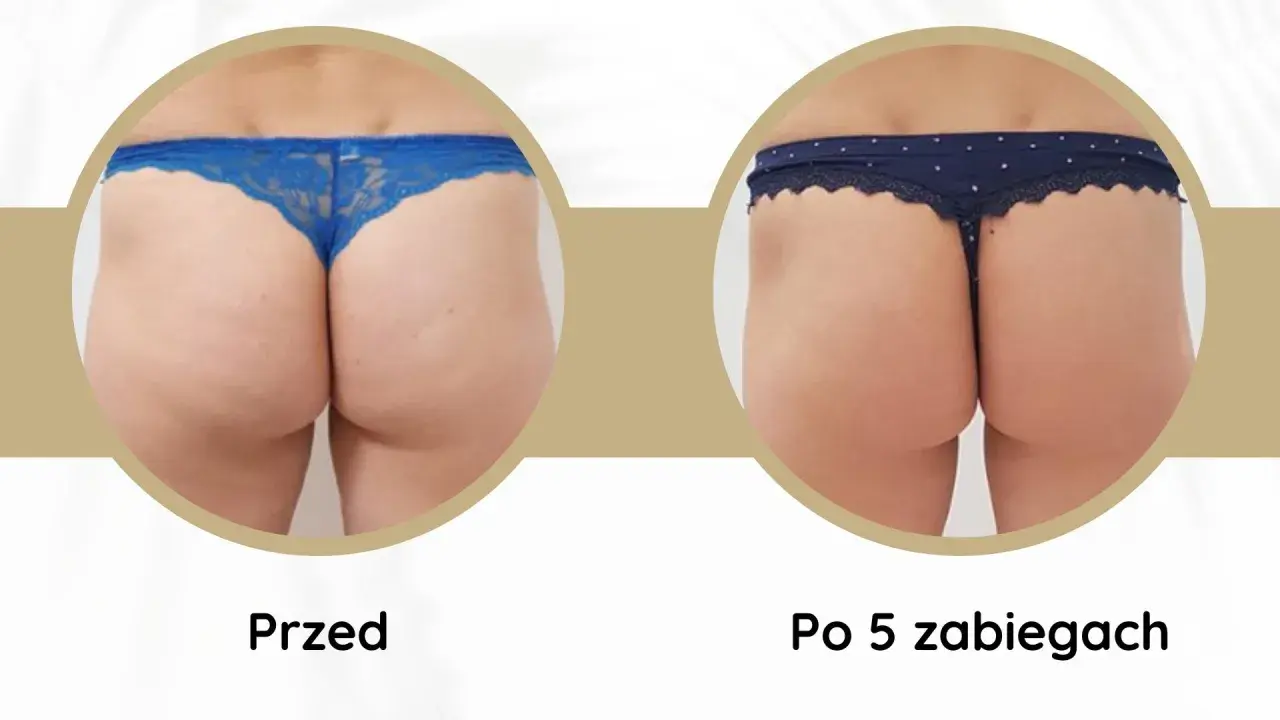 Porównanie pośladków przed i po 5 zabiegach endermologii. Widoczne wygładzenie skóry i redukcja cellulitu. Endermologia efekty.