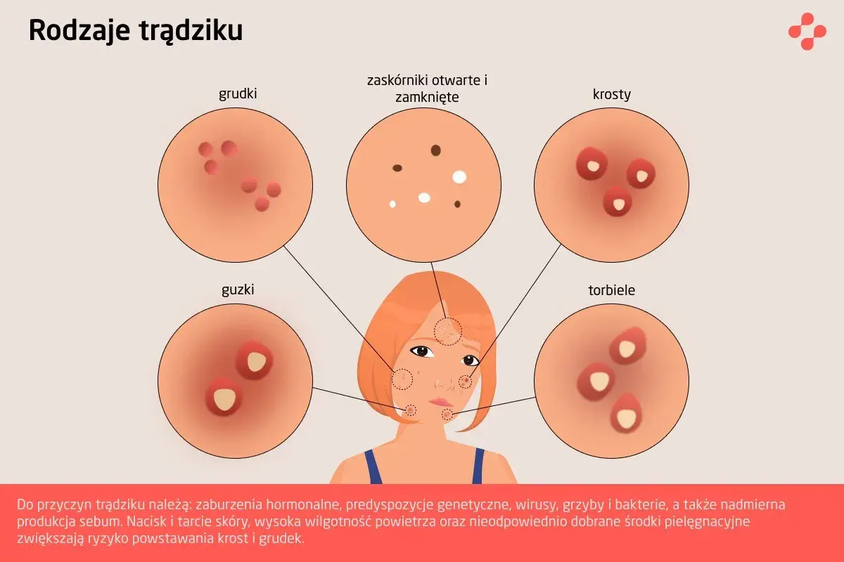 Ilustracja pokazuje różne rodzaje trądziku: grudki, zaskórniki, krosty, guzki i torbiele.