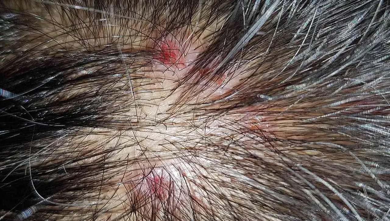 Widoczne zaczerwienione, podrażnione miejsca na skórze głowy, wskazujące na zapalenie mieszków włosowych. Włosy są gęste, a skóra lekko łuszcząca się.
