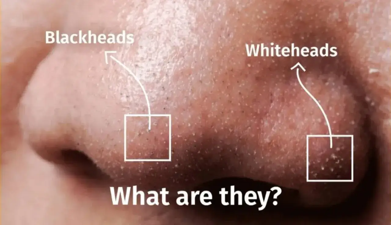 Zbliżenie na skórę nosa z widocznymi zaskórnikami otwartymi (blackheads) i zamkniętymi (whiteheads).